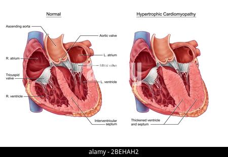 Hypertrophe Kardiomyopathie Stockfoto