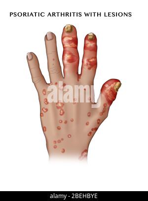 Illustration der psoriatischen Arthritis mit Läsionen. Stockfoto