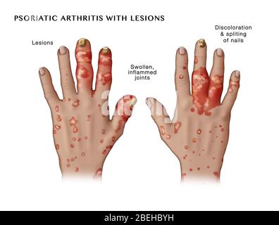 Psoriatische Arthritis mit Läsionen Stockfoto