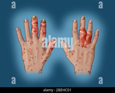 Illustration der psoriatischen Arthritis. Stockfoto