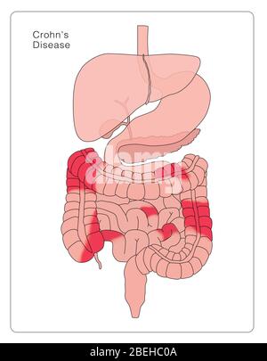 Morbus Crohn Stockfoto