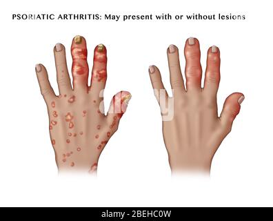 Psoriatische Arthritis mit und ohne Läsionen Stockfoto