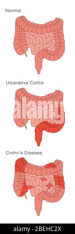 Morbus Crohn & Colitis ulcerosa, Vergleich Stockfoto