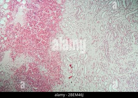 Poly Nephritis, Gewebe unter dem Mikroskop 100x Stockfoto
