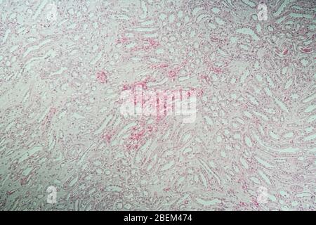 Poly Nephritis, Gewebe unter dem Mikroskop 100x Stockfoto
