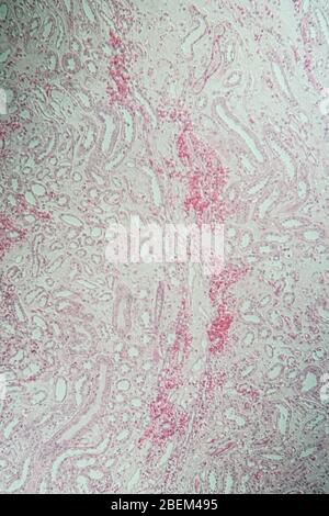 Poly Nephritis, Gewebe unter dem Mikroskop 100x Stockfoto