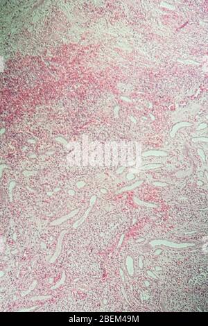 Poly Nephritis, Gewebe unter dem Mikroskop 100x Stockfoto