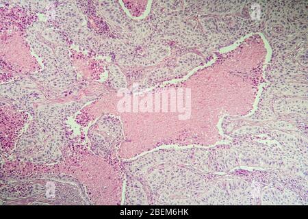 Plattenepithelkarzinom erkranktes Gewebe unter dem Mikroskop 100x Stockfoto