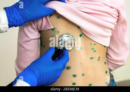 Arzt, der ein Kind mit Stethoskop untersucht, das mit grünen Ausschlägen auf dem Rücken bedeckt ist, der an Windpocken, Masern oder Röteln erkrankt ist. Stockfoto