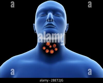 Illustratives Konzept des Coronavirus in der menschlichen Kehle, bevor es in die Lunge gelangt. Stockfoto