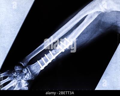 Titanplatte auf Radiusknochen in einem diagnostischen Röntgenbild nach chirurgischem Eingriff Stockfoto