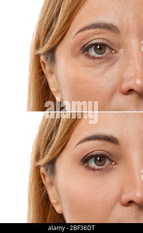 Frau vor und nach der plastischen Chirurgie auf weißem Hintergrund, Nahaufnahme Stockfoto