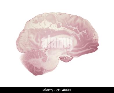 Median Abschnitt Des Gehirns, Anatomie Des Menschlichen Gehirns Stockfoto
