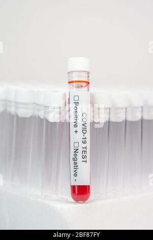 Vertikale Nahaufnahme der Testprobe des COVID-19-Infektionsblutes Stockfoto