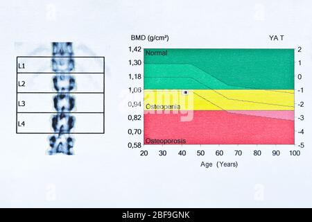 Bild des dxa-Knochendichtescans bei einer Frau von 42 Jahren zur Vorbeugung von Osteoporose. Stockfoto