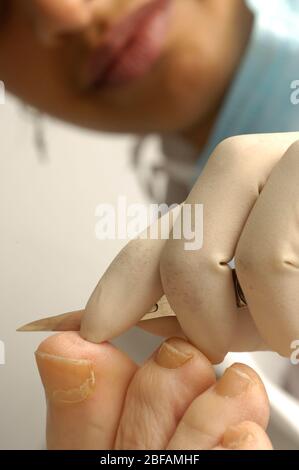 Chiropodist mit einem Skalpell, um gehärtete und versteinerte Haut vom Fuß eines Patienten zu entfernen. Stockfoto
