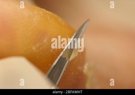 Chiropodist mit einem Skalpell, um gehärtete und versteinerte Haut vom Fuß eines Patienten zu entfernen. Stockfoto