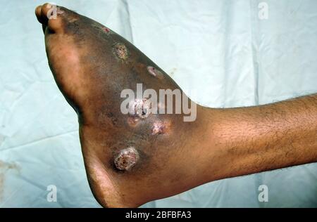 Nahaufnahme des Myketoms am linken Fuß eines jungen männlichen Patienten. Myketom ist eine seltene Krankheit, die in den Tropen gefunden wird. Es handelt sich um eine chronische, lokalisierte Infe Stockfoto
