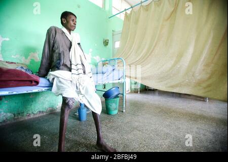 Ein junger sudanesischer Erwachsener, der an einem Myzetom am rechten Knie leidet. Der Patient ist auch unterernährt. Myketom ist eine seltene Krankheit in der gefunden Stockfoto