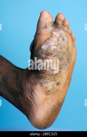 Die Fußsohle eines jungen Mannes, der an Mycetoma leidet. Myketom ist eine seltene Krankheit, die in den Tropen gefunden wird. Es handelt sich um eine chronische, lokalisierte Infectio Stockfoto