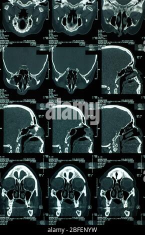 Eine Nahaufnahme einer Reihe von CT-Scans, die den Schädel eines Patienten zeigen. Stockfoto