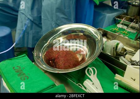 Kranke Leber In Silber Schale Nach Lebertransplantation Stockfotografie Alamy