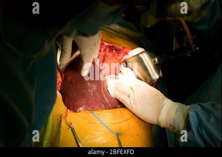 Chirurgen, die eine Lebertransplantation im Samsung Medical Center, Seoul, Südkorea durchführen Stockfoto