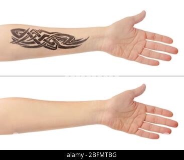 Tattoo auf männliche Hand. Laser Tattoo Entfernung Konzept Stockfoto
