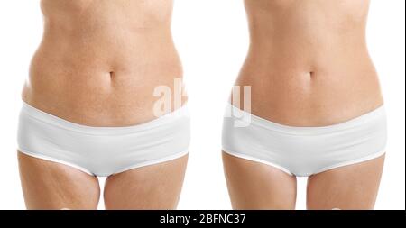 Reife Frau Körper vor und nach Fettabsaugung. Konzept der plastischen Chirurgie. Stockfoto