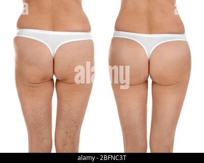 Reife Frau Körper vor und nach Fettabsaugung. Konzept der plastischen Chirurgie. Stockfoto