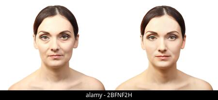 Gesicht der Frau vor und nach kosmetischen Verfahren. Konzept der plastischen Chirurgie. Stockfoto