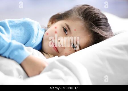 Kleines Mädchen mit roten Pickel, das zu Hause im Bett liegt. Chicken Pox Konzept Stockfoto