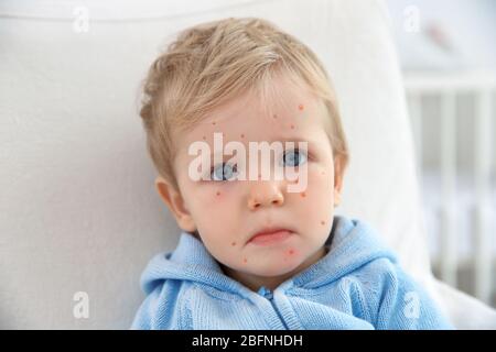 Kleiner Junge mit roten Pickel zu Hause. Chicken Pox Konzept Stockfoto