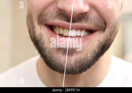 Ergebnis der Zahnaufhellung. Lächelnder junger Mann, Nahaufnahme Stockfoto
