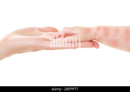 Mutter, die Hand des kleinen Kindes mit rotem Ausschlag auf weißem Hintergrund, Nahaufnahme. Konzept der Babys Allergien Stockfoto