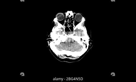 MRT-Untersuchung des Gehirns mit Hämatom. Realer Kernspintomographie-Scan. Stockfoto