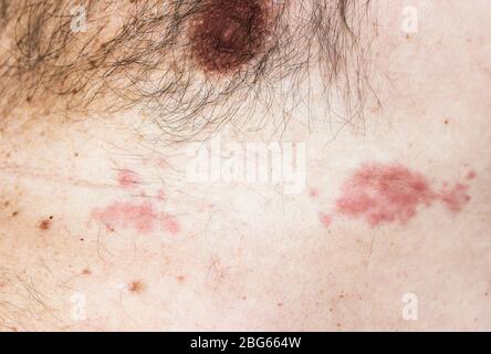 Frühe Stadien des Ausschlags des Varicella-Zoster-Virus bei einem älteren kaukasischen Männchen. Stockfoto