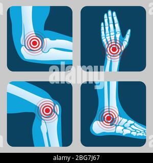 Menschliche Gelenke mit Schmerzringen. Infografik zu Arthritis und Rheuma. Vektorschaltflächen für medizinische Anwendungen. Erkrankungen in Gelenkknochen, Knie, Bein und Hand Illustration Stock Vektor