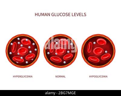 Humanen Glukosespiegel Hyperglykämie, normal, Hypoglykämie. Hämatologie-Vektordiagramm mit Blutgefäß, Erythrozyten und Zucker. Illustration von Diabetikern Stock Vektor
