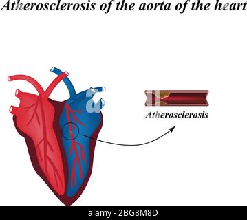 Arteriosklerose der Arterien des Herzens. Infografiken. Vektorgrafik Stock Vektor