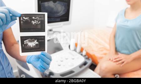 Der Arzt, der in der Hand hält, Ergebnisse einer transvaginalen Eierstocksonographie. Gynäkologie Stockfoto