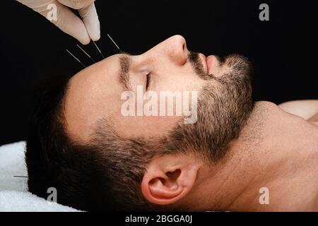 Akupunktur Behandlung, um Stress zu entlasten und entspannen Sie den Körper Mann. Nahaufnahme Akupunkturnadeln in der Stirn eines Mannes auf schwarzem Hintergrund. Stockfoto