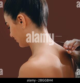 Akupunkturnadeln in der Wirbelsäule einer Frau Nahaufnahme auf einem braunen Hintergrund. Reflexologe sehr genau tun Akupunktur. Osteochondrose-Behandlung Stockfoto