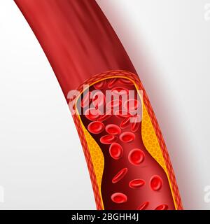 Blutgefäß blockiert, Arterie mit Cholesterin Thrombus. 3d-Vene mit Darstellung des Gerinnungsvektors. Arteria Medical Blut, Cholesterin-Erkrankung, blockierte Durchblutung Stock Vektor