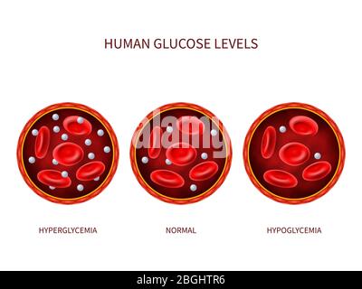 Humanen Glukosespiegel Hyperglykämie, normal, Hypoglykämie. Hämatologie-Vektordiagramm mit Blutgefäß, Erythrozyten und Zucker. Illustration von diabetischer Erkrankung, Krankheitsdiagnose Stock Vektor