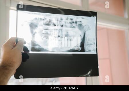 Hand hält Röntgenaufnahme eines Kiefers Stockfoto