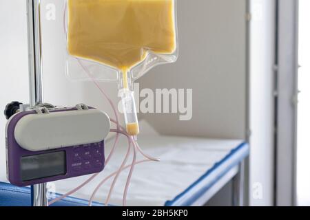 Fütterungspumpe medizinisches Gerät lila Farbe zu ergänzen Ernährung Flüssigkeit Nahrung zu Sonde enterale Fütterungsflüssigkeit Set Beutel mit Klemme hängen auf Ständer. Stockfoto