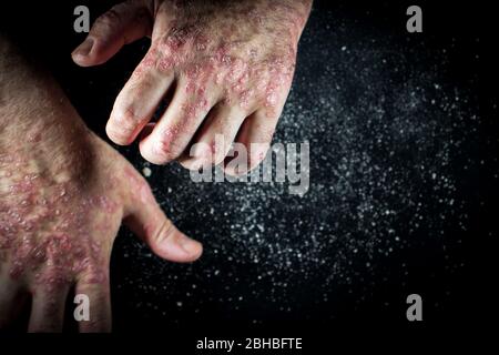 Psoriasis (Ekzem) auf der Hand Mann Juckreiz Haut Psoriasis Schuppen sind auf schwarzem Hintergrund verstreut Stockfoto