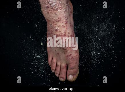 Psoriasis (Ekzem) am Fuß Mann Juckreiz Haut Psoriasis Schuppen sind auf schwarzem Hintergrund verstreut Stockfoto