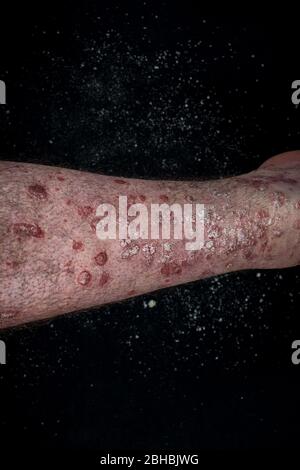 Psoriasis (Ekzem) am Fuß Mann Juckreiz Haut Psoriasis Schuppen sind auf schwarzem Hintergrund verstreut Stockfoto